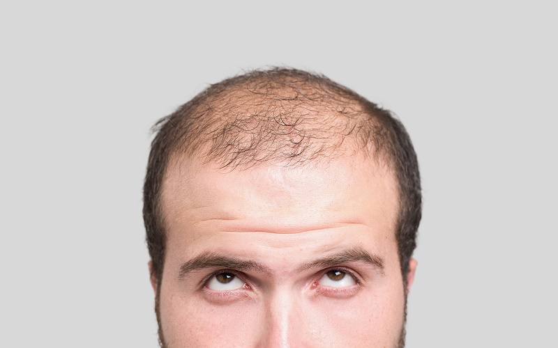 درمان کم پشتی و نازکی موی سر