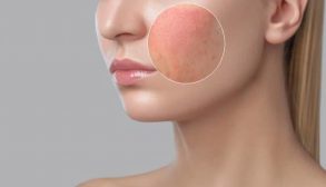 Symptoms-demodex-parasites-300x157